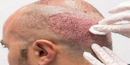 كيفية اختيار أفضل دكتور لزراعة الشعر في مصر - ترند نيوز