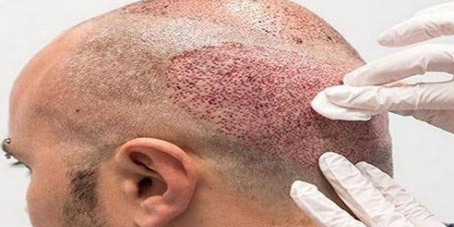 كيفية اختيار أفضل دكتور لزراعة الشعر في مصر - ترند نيوز