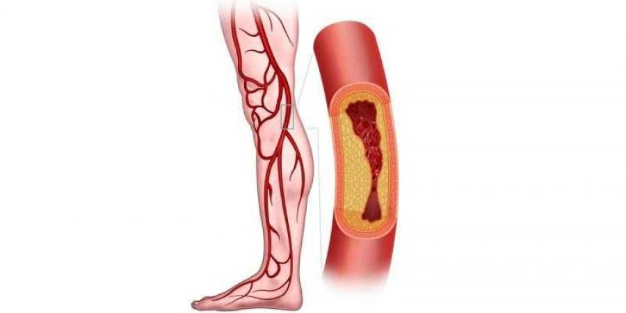 عوامل خطر تصلب شرايين الساقين - ترند نيوز