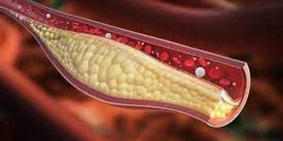 معلومات مهمة لمرضى الكوليسترول الضار بالدم - ترند نيوز